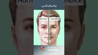 What is yellow jaundice? #jaundice #drfaisaldar #yellowjaundice #shortsfeed