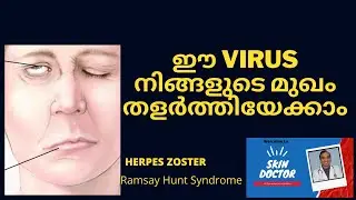 Herpes zoster Malayalam/Ramsay hunt syndrome herpes zoster/herpes zoster oticus|Bell's palsy