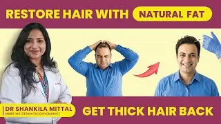 Nanofat Grafting for Hair Fall: Stem Cell Therapy Explained by Dermatologist