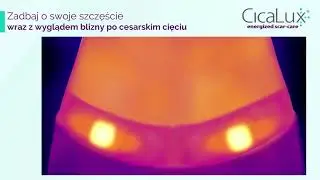 Leczenie blizn blizny zestawem CicaLux Energized Scar-Care