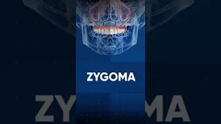 Скуловая имплантация Zygoma #smile #smilemakeover #виниры #винирыназубы #dentalclinic