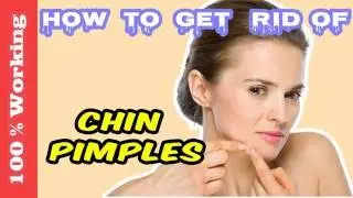 How To Get Rid Of Pimples On Chin Overnight - Fast - Home Remedies - Blackheads - Acne - Remove
