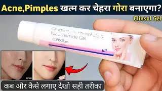 Clinsol Gel Review | clinsol gel | clinsol gel how to use