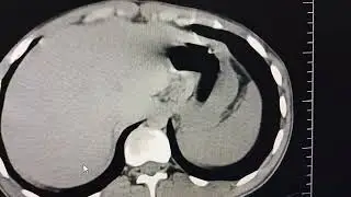 CT SCAN IN DETECTION OF INGESTED HEROINE CAPSULES -CASE BY DR UMAR AMIN