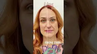 How HA Filler Creates a More Harmonious, Youthful Look