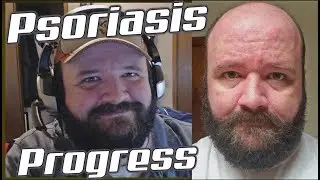 VLOG: 3-ish Weeks into Taltz Treatment! (Psoriasis)