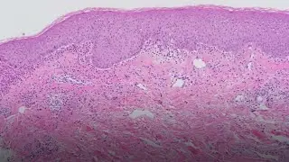 Collagen VII Autoantibody-mediated Subepidermal Autoimmune Blistering Diseases