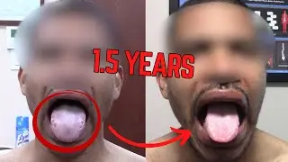 Swollen Tongue for 1.5 Years — Watch the Difference After This