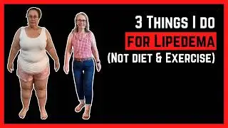 Top 3 Must-Do Tips for Lipedema Relief