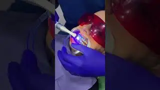 تجربتى مع تبييض الاسنان ♥️🦷🪥🦷🪥♥️