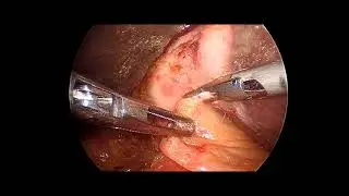 small shrunken fibrotic gall bladder - difficult lap chole video 16