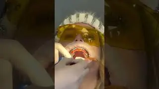 Laser Teeth Bleaching | Maltepe Dental Clinic