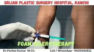 varicose veins treatment before SSC GD medical| Foam Sclerotherapy treatment for varicose veins