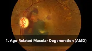 Age Related Macular Degeneration (AMD)