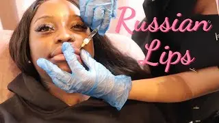SIGNATURE RUSSIAN LIPS TECHNIQUE | Lip Fillers Before & After | Full Procedure at Astra Faces