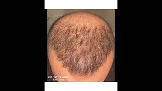DHI Hair Transplant-  [ 3 months result ] 4300 graft - Dr. Serkan Aygın Clinic