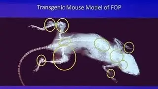 Genetic Mysteries: FOP - When Bodies Turn to Bone