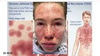 Stevens-Johnson Syndrome Explained | Causes, Symptoms & Management 