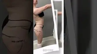 This beautiful transformation is the result of a Brazilian Butt Lift #smartplasticsurgery #bodygoals