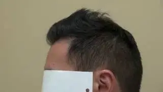 FUE Hair Transplant Result 1 Year Follow Up Hairline Asian Man Dr. Diep www.mhtaclinic.com