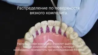 Шинирование зубов при пародонтите при помощи ленты Ribbond