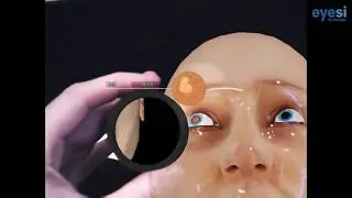 Eyesi Indirect Ophthalmoscope Simulator de VRmagic pr&eacute;sent&eacute; par Promamec lors de la EYECUP