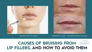 Causes of Bruising and Swelling from Lip Filler Treatment, and How they Can be Avoided