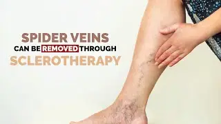 Spider Veins Treatment | What Causes Spider Veins on Legs | For Appointment: 910 850 3874