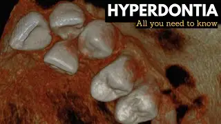 Hyperdontia, Causes, Signs and Symptoms, Diagnosis and Treatment.