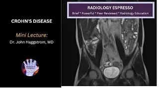 CROHN&rsquo;S DISEASE: Case Example &ndash; Acute Crohn&rsquo;s disease on MRI (4340)