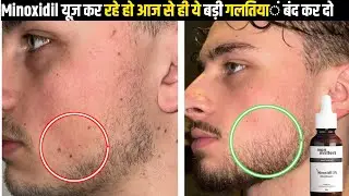 ये तीन गलतियां सभी करते है | Minoxidil Beard Growth Mistake | Minoxidil Beard | Derma Roller