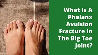 What Is A Phalanx Avulsion Fracture In The Big Toe Joint?