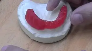 Restoration with a Screw Retained Prosthesis