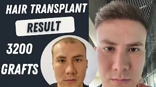 Hair Transplant 3200 Grafts Result Timeline 12 months | Istanbul Hair Transplant Before and After