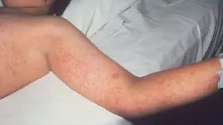 Measles case in Greater New Orleans confirmed by LDH
