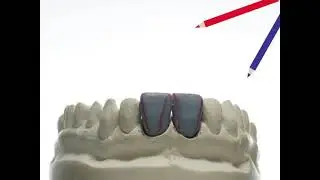 Wax-up начальные этапы моделирования фронтальных резцов из воска