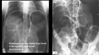 Abnormal KUB findings for medical students