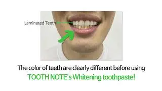 Does Whitening Toothpaste work on the laminated teeth?