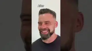 Hair Transplant Result | Hair Transplant Timelapse | Hair Transplan Before and After 5000 grafts
