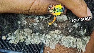 Psoriasis Scalp Scratching Big Flakes #943
