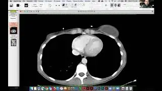 Abdominal pain after myomectomy (Victor Sai)