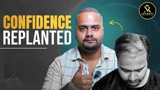Hair Transplant Surgery in Kolkata (Grade 5 Baldness)🙂 | New Roots