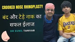 Life-Changing Rhinoplasty Experience | From Crooked Nose & Breathing Issues to Confidence | Dr Sunil