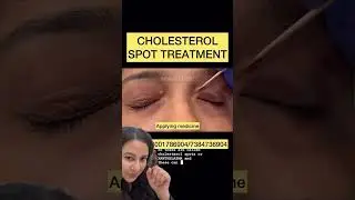 Xanthelasma treatment. #shorts #dermshorts