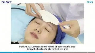 SFMS Treatment for Facial Aging: Full Procedural Demonstration