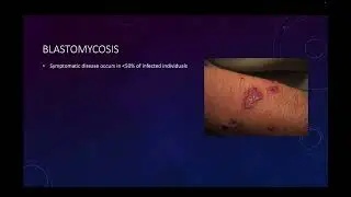 53 - Systemic Mycoses Part 01