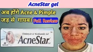 AcneStar Cream | AcneStar Gel Review | Acnestar gel Side Effects & Uses