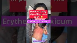 Newborn baby ki body me rash! 😳| erythema toxicum #shorts #ytshorts #baby #awareness