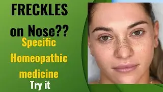 Best medicine  for Black pigmentation/Freckles on Nose.