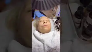 medium-depth chemical peel